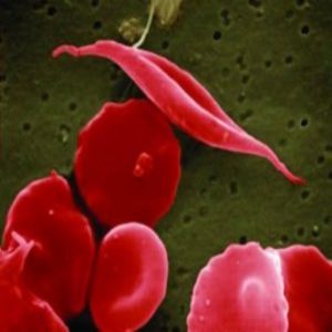 Sickle cell disease