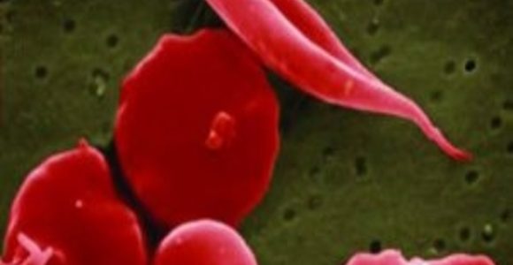 Could Gene Therapy Be a Treatment for Sickle Cell Disease?