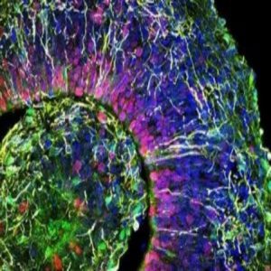 A human brain organoid derived from a patient with autism spectrum disorder