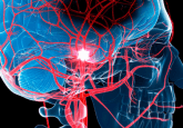 Stroke gene therapy