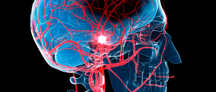 Stroke gene therapy