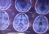 Obesity and Alzheimer’s link brain MRI scan