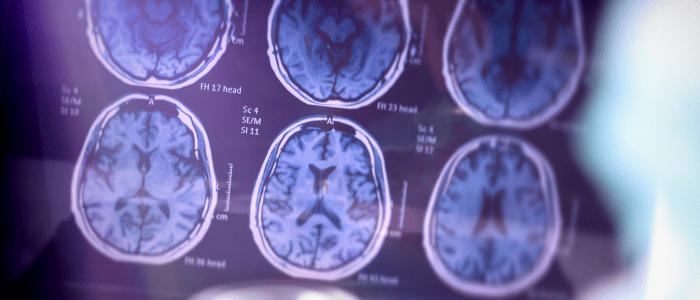 Obesity and Alzheimer’s link brain MRI scan