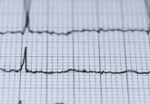 atrial fibrillation ECG to predict stroke risk