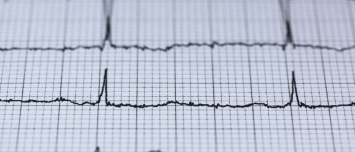 atrial fibrillation ECG to predict stroke risk