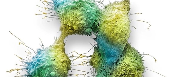 Cancer tumor cells metastasizing