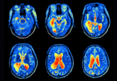 MRI images of the brain for predicting Alzheimer's onset