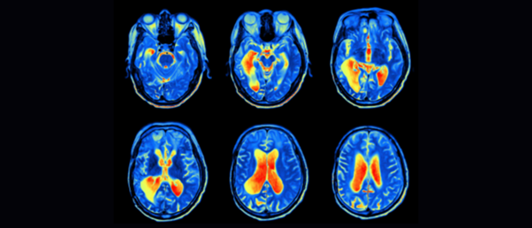 MRI images of the brain for predicting Alzheimer's onset