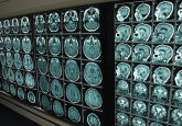 Alzheimer's disease risk brain scans images