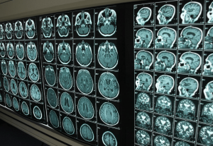 Alzheimer's disease risk brain scans images
