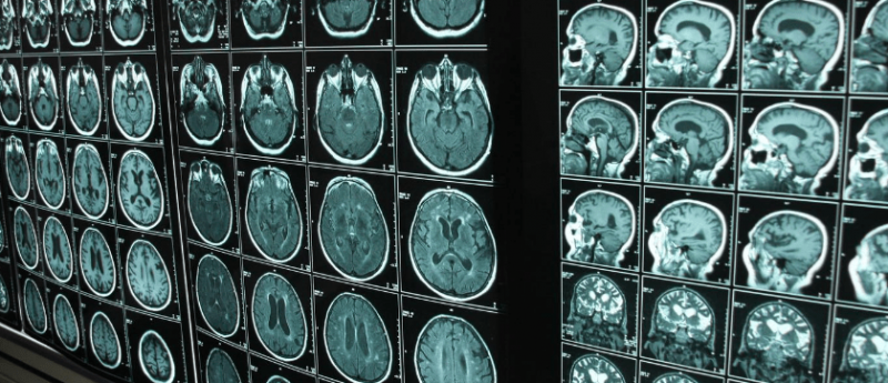 Alzheimer's disease risk brain scans images